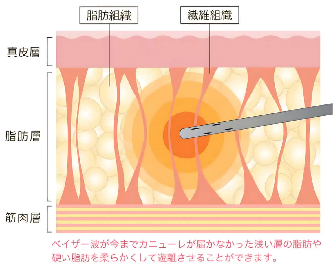 VESER脂肪吸引の特徴