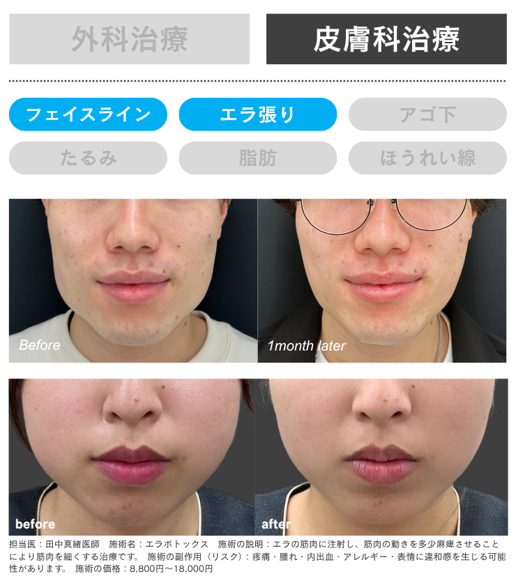 手軽な小顔治療！