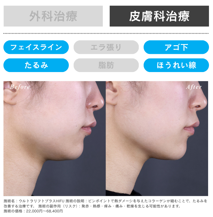 切らないたるみ治療なら湘南の医療HIFU！