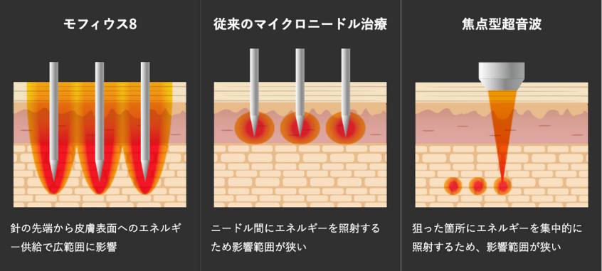 目元やお顔のたるみに効果的!