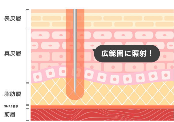 皮膚層〜脂肪層まで届く熱伝導