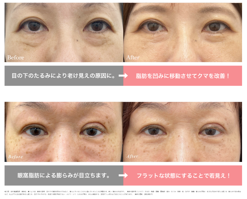 裏ハムラ法の症例写真