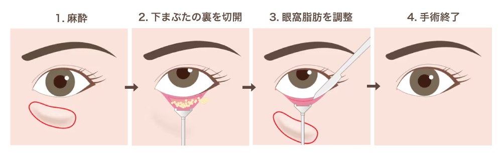 凹みと膨らみを同時に改善!