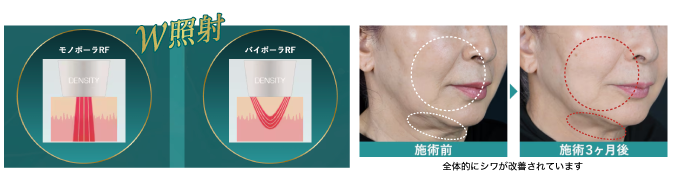 皮膚の表層から深部まで照射