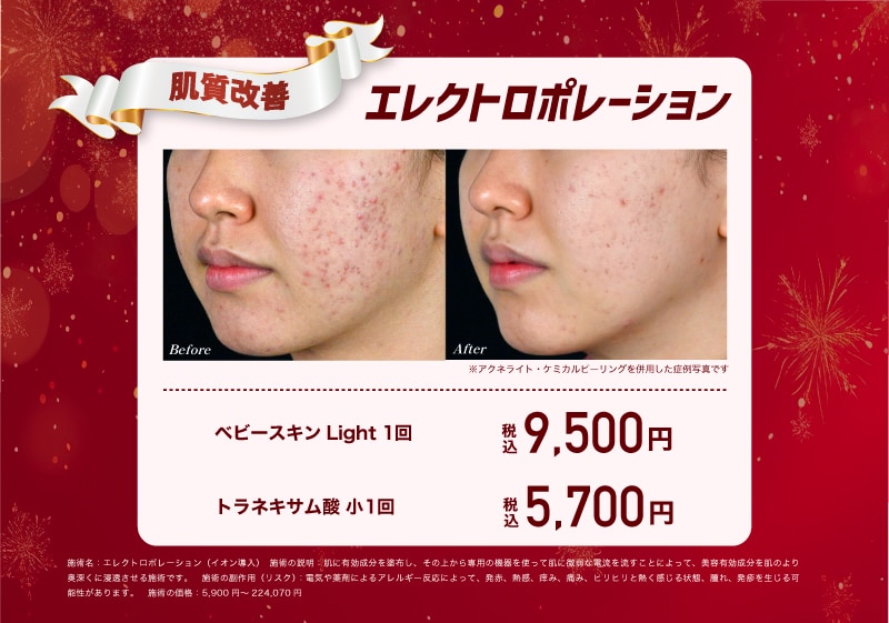 エレクトロポレーション