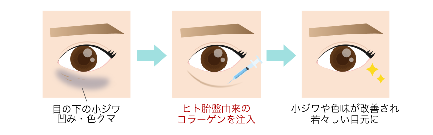 皮膚科治療で叶えるクマ改善