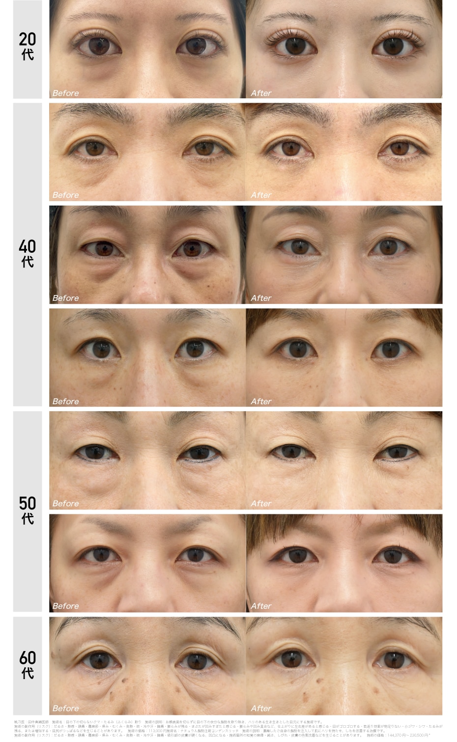クマ取り＋脂肪注入