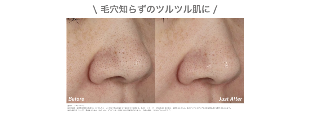 ブラックピール＆エレクトロポレーション