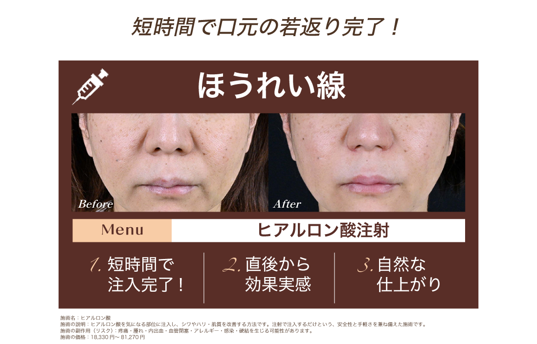 ヒアルロン酸注射