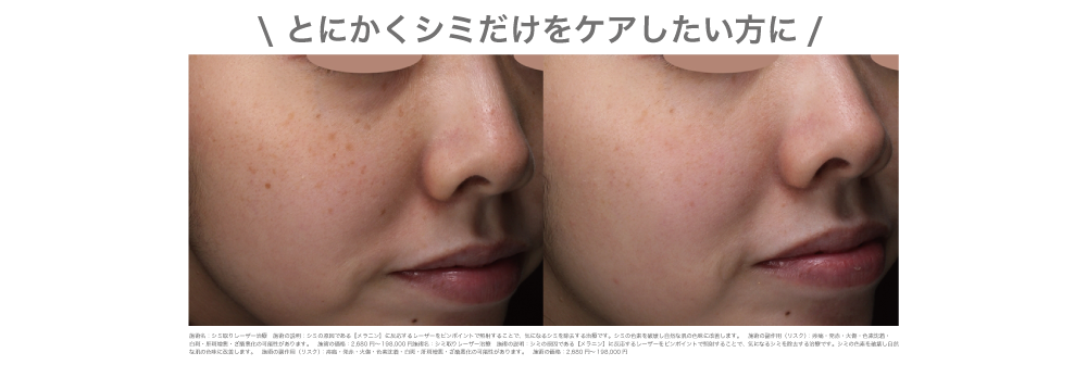 シミ取りレーザー