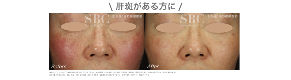 ピコトーニング