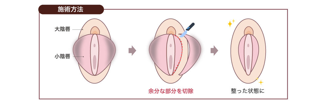 【びらびらのお悩みに】小陰唇縮小術