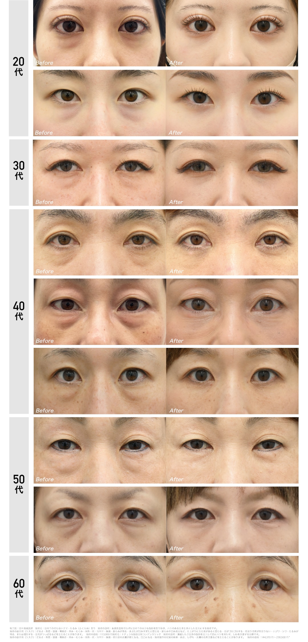クマ取り＋脂肪注入