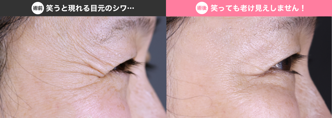 年々増えていく小ジワ