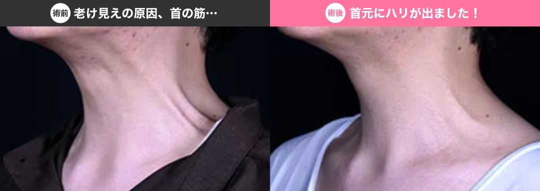 加齢、スマホやPCによる前屈み姿勢が原因に…