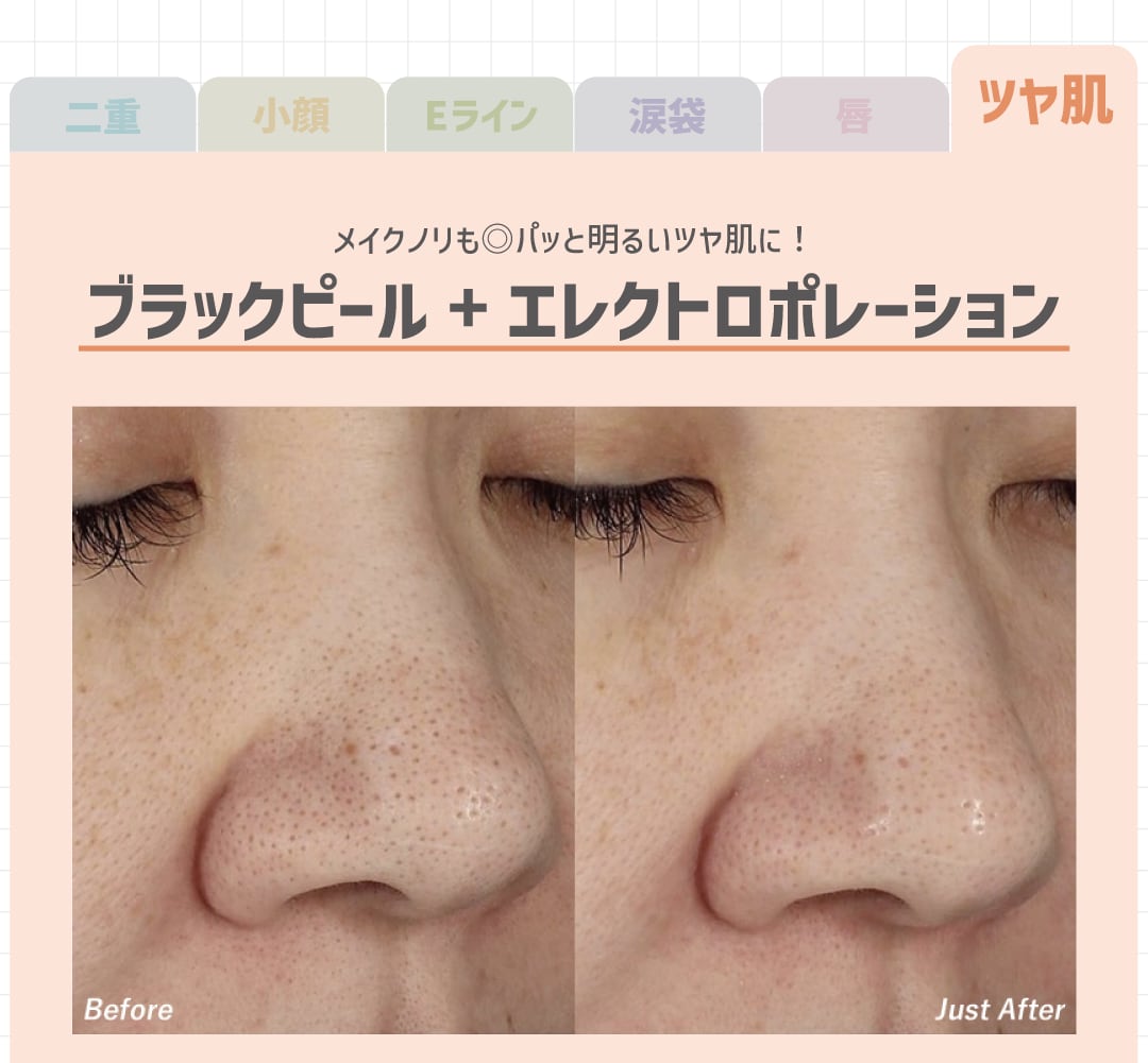 ブラックピール＆エレクトロポレーション