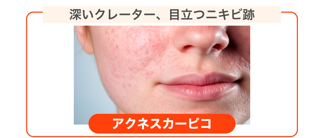 ボコボコした肌を根本から治したい、ピコフラクショナルより強い効果を求めている方に