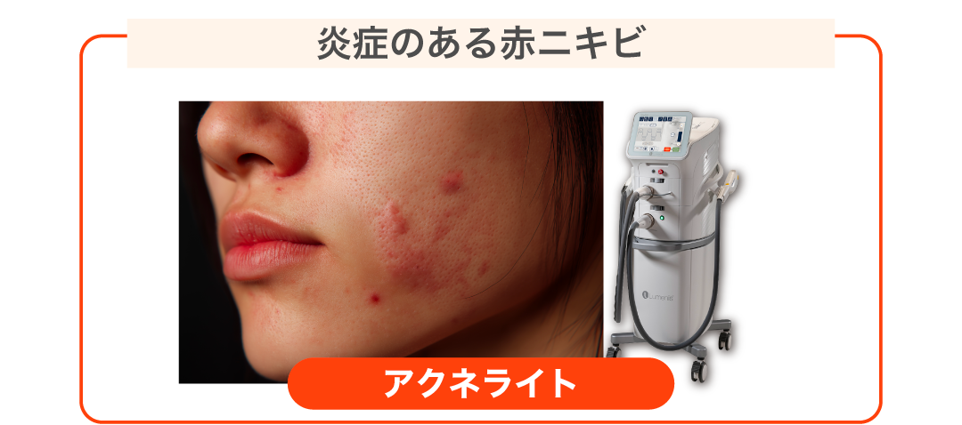 繰り返す赤ニキビ、ニキビの炎症による赤みに