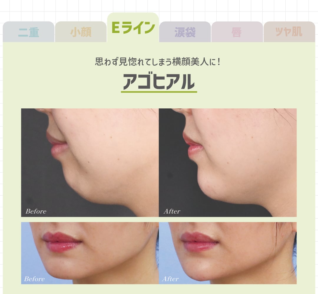 アゴヒアルロン酸