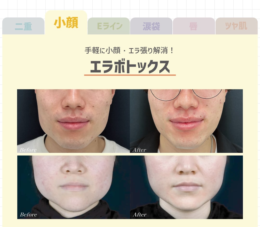 エラボトックス