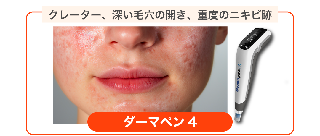 肌質をガラッと変えたい、薬剤をしっかり浸透させたい方に