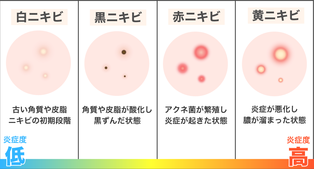 皮脂・角質・アクネ菌などさまざま