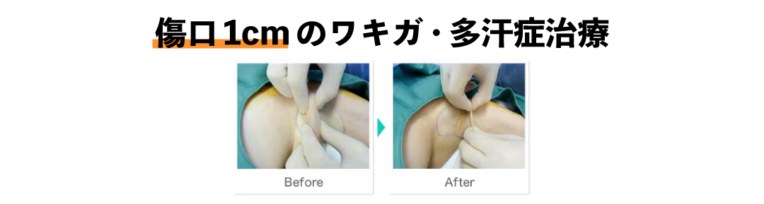 根こそぎベイザーシェービング法