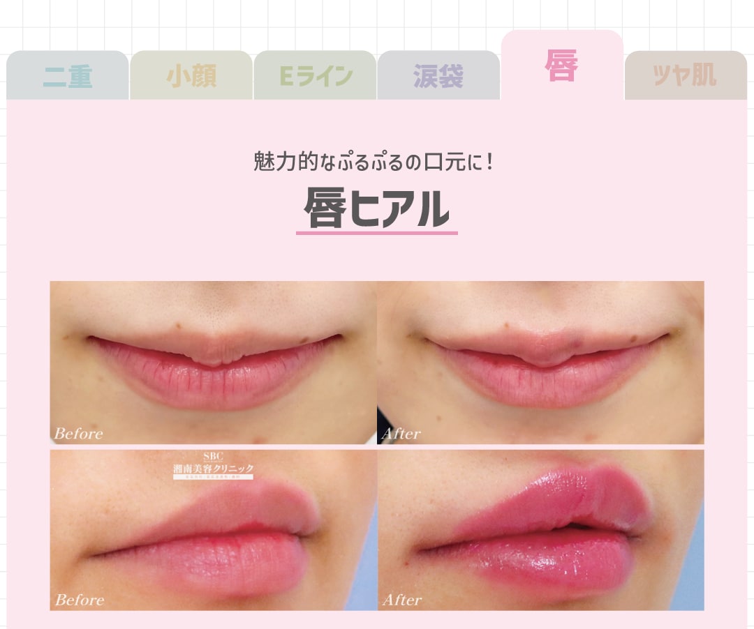 唇ヒアルロン酸