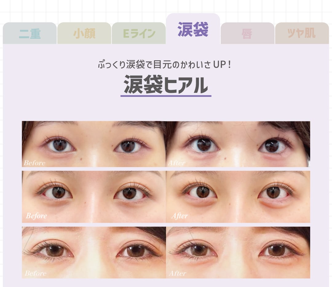 涙袋ヒアルロン酸