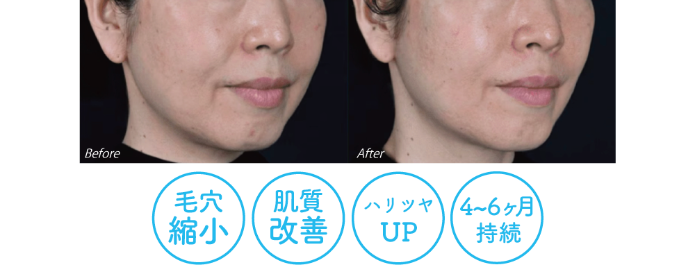 肌質改善&肌の引き締めも
