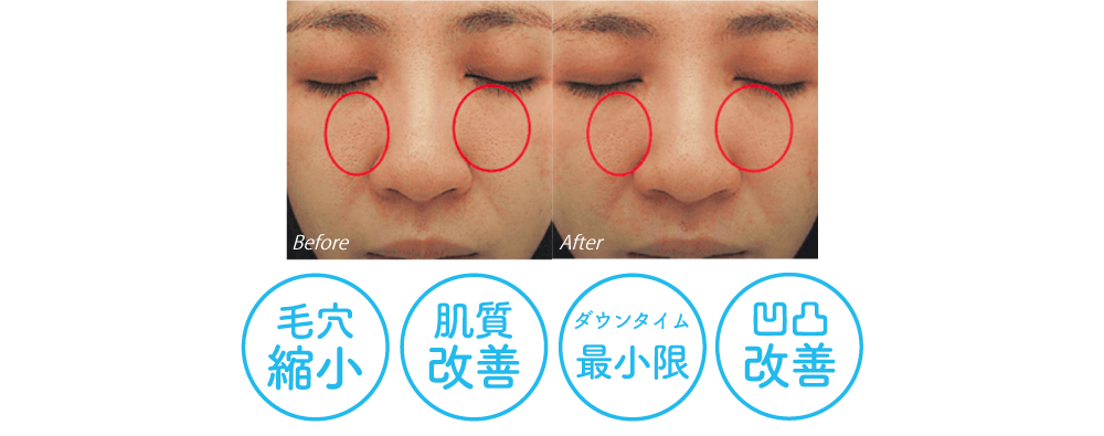 凹凸を改善してハリのある肌に