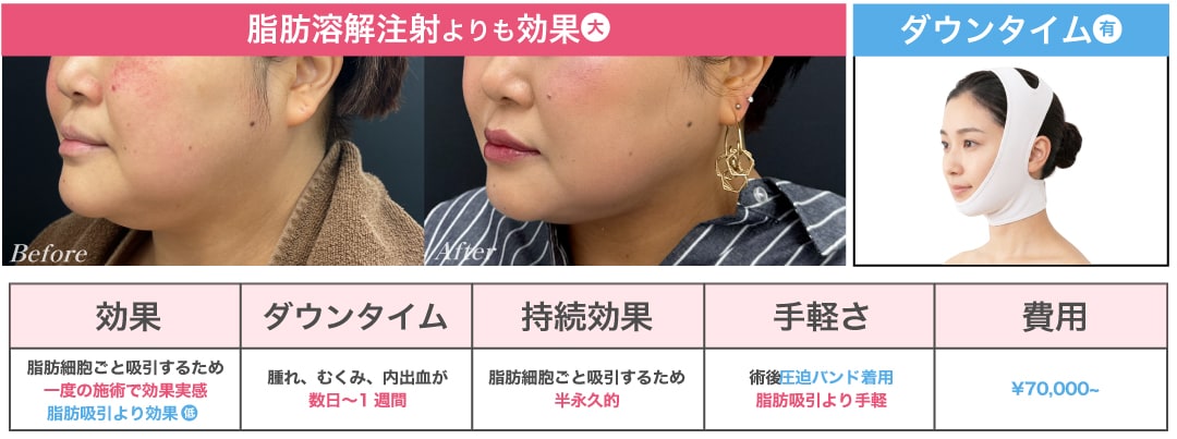 脂肪吸引よりも手軽