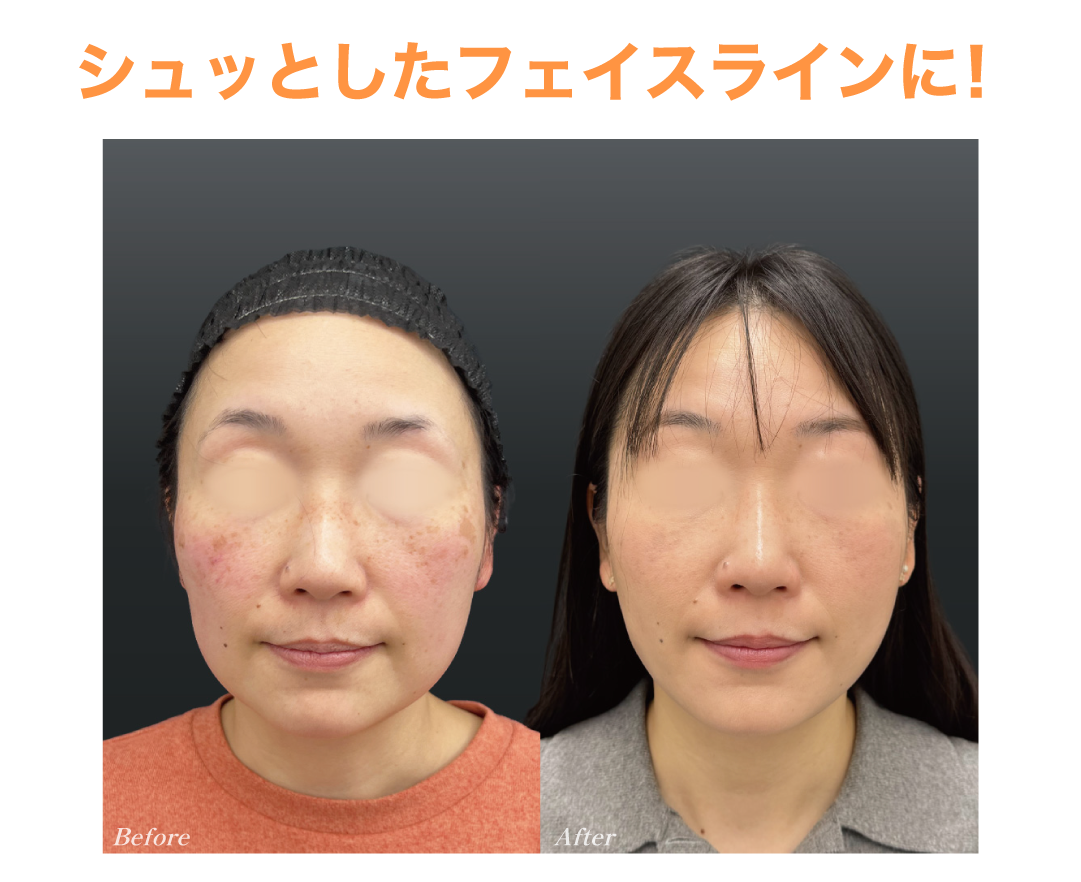脂肪吸引