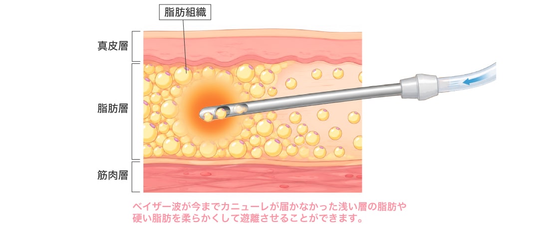 VESER脂肪吸引の特徴