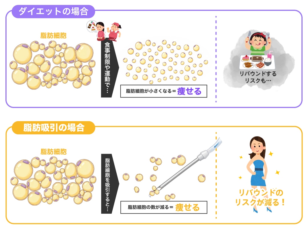 脂肪細胞ごと吸引するから痩せる！