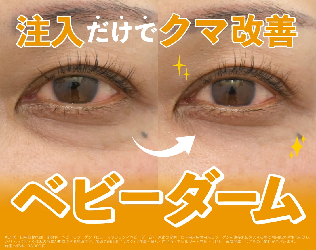 【直後から変わる】注入でクマ改善できるベビーダームとは？/湘南美容クリニック長岡院