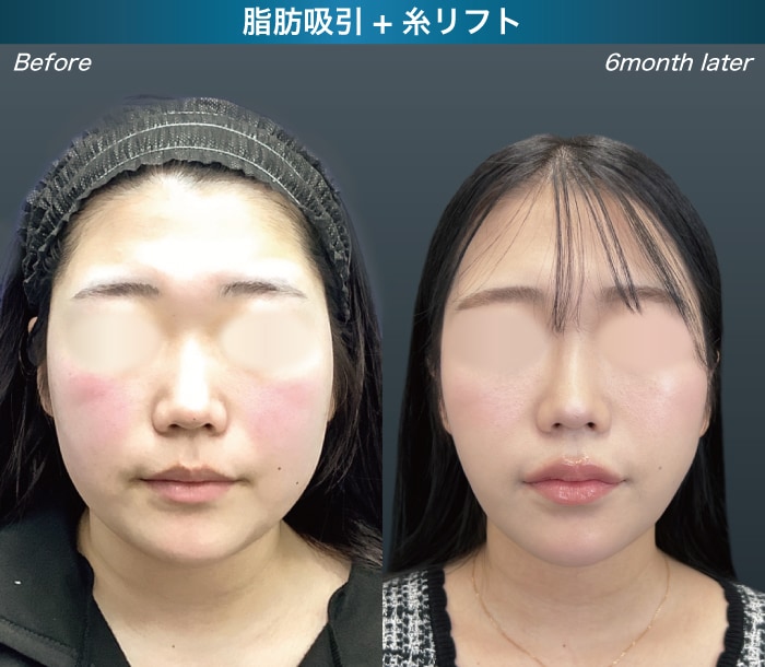 顔の脂肪吸引