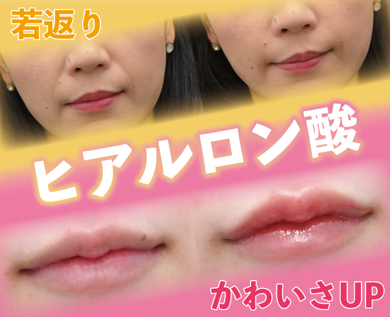 可愛さUPも若返りも！ヒアルロン酸注射なら湘南美容クリニック長岡院へ！