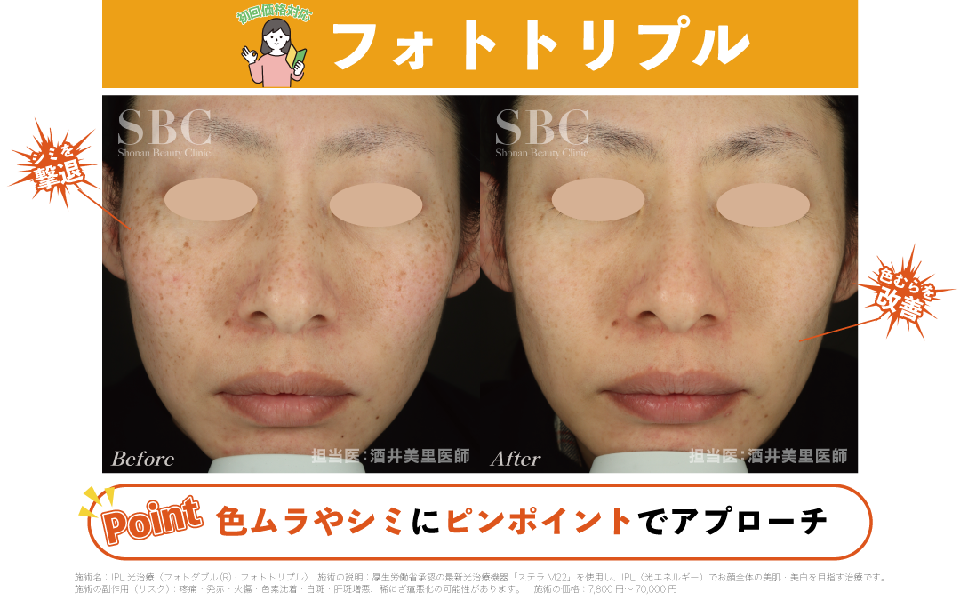 No.6| IPL光治療でシミ・くすみ・そばかすを改善！