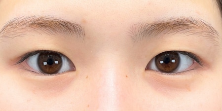 {クイックコスメティークダブル・NEO} {10代}  {女性} の術前の症例写真