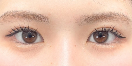 {クイックコスメティークダブル・NEO} {10代}  {女性} の術後の症例写真