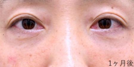 {裏下ナノ} {40代} {男性} の術後の症例写真