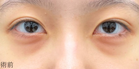 {裏下リッチ} {10代} {女性} の術前の症例写真