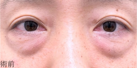 {裏下ナノ} {40代} {男性} の術前の症例写真