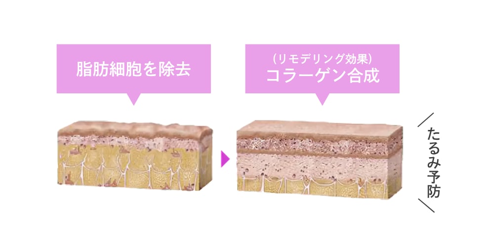 従来の脂肪溶解注射よりさらにパワーアップ！？