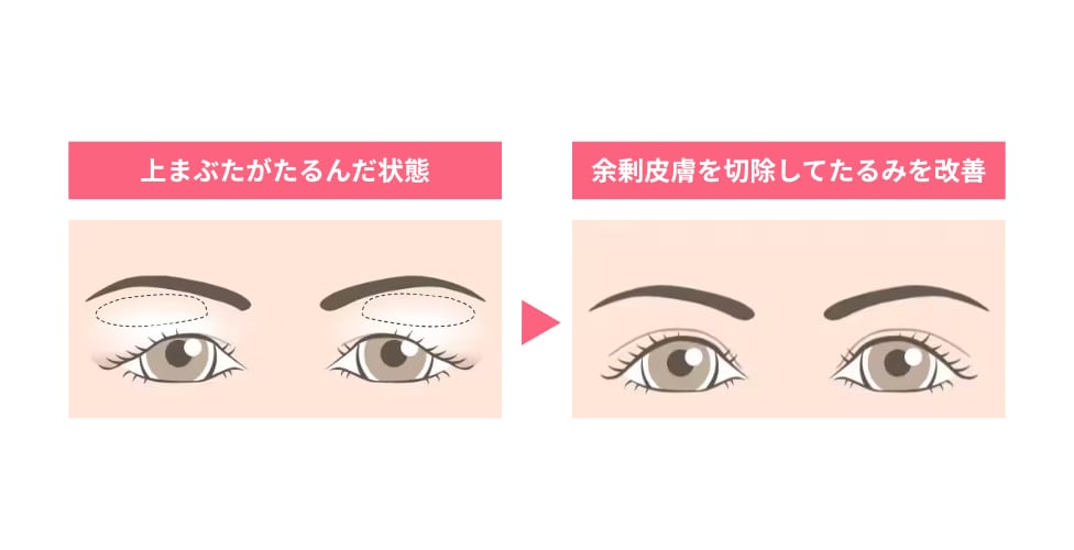 眉下リフト