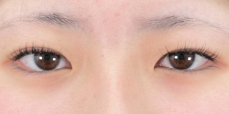 {クイックコスメティークダブル・NEO} {10代}  {女性} の術前の症例写真