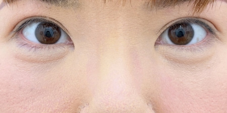 {裏下ナノ} {40代} {男性} の術後の症例写真