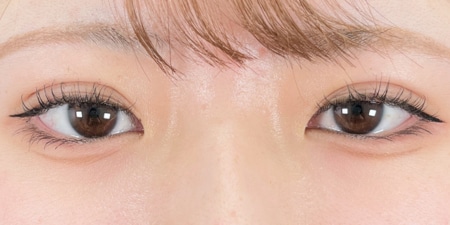 {クイックコスメティークダブル・NEO} {10代}  {女性} の術後の症例写真