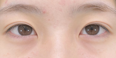 {クイックコスメティークダブル・NEO} {10代}  {女性} の術前の症例写真